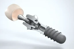 3d-produktvisualisierung-zahnimplantat-explosionsdarstellung